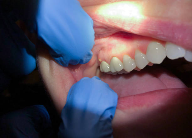 Best Broken or Cracked Tooth Emergency Dentist in Okeechobee, FL